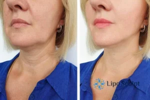 Double chin before and after Hi-Fu treatment 4 Book your double chin treatment Billericay today! We are here to help!