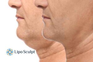 Double chin before and after Hi-Fu treatment 2 Double chin treatment Billericay from Lipo Sculpt - feel more confident today!