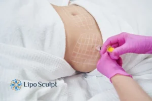 Are The Results From Aqualyx Permanent? 1 Do you want to know how long Aqualyx Billericay results last?