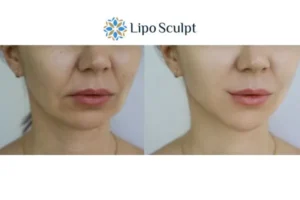 Explaining Total Skin Tightening Treatment And What It Can Do For You 2 Do you want to boost your self confidence? Give Morpheus8 Billericay a try today!