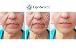 Explaining Total Skin Tightening Treatment And What It Can Do For You 3 Boost your confidence with Morpheus8 Billericay call our team today!