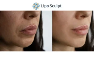 Explaining Total Skin Tightening Treatment And What It Can Do For You 4 Morpheus8 Billericay the best results - call our team today!