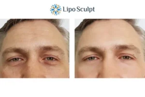 Explaining Total Skin Tightening Treatment And What It Can Do For You 6 Morpheus8 Billericay book in today to find out more!