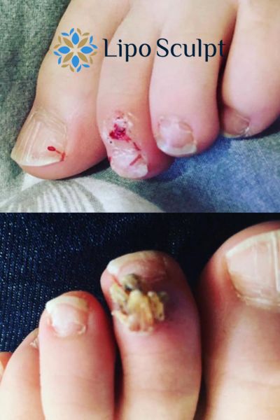 Wart removal customer results from Lipo Sculpt Billericay