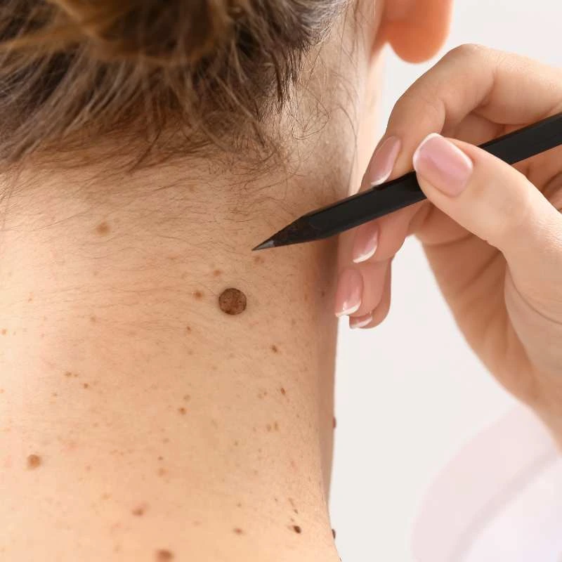 How to Support Your Body During Pregnancy for Faster Postnatal Recovery 5 See our lesion removal prices Billericay - call today for a free quote